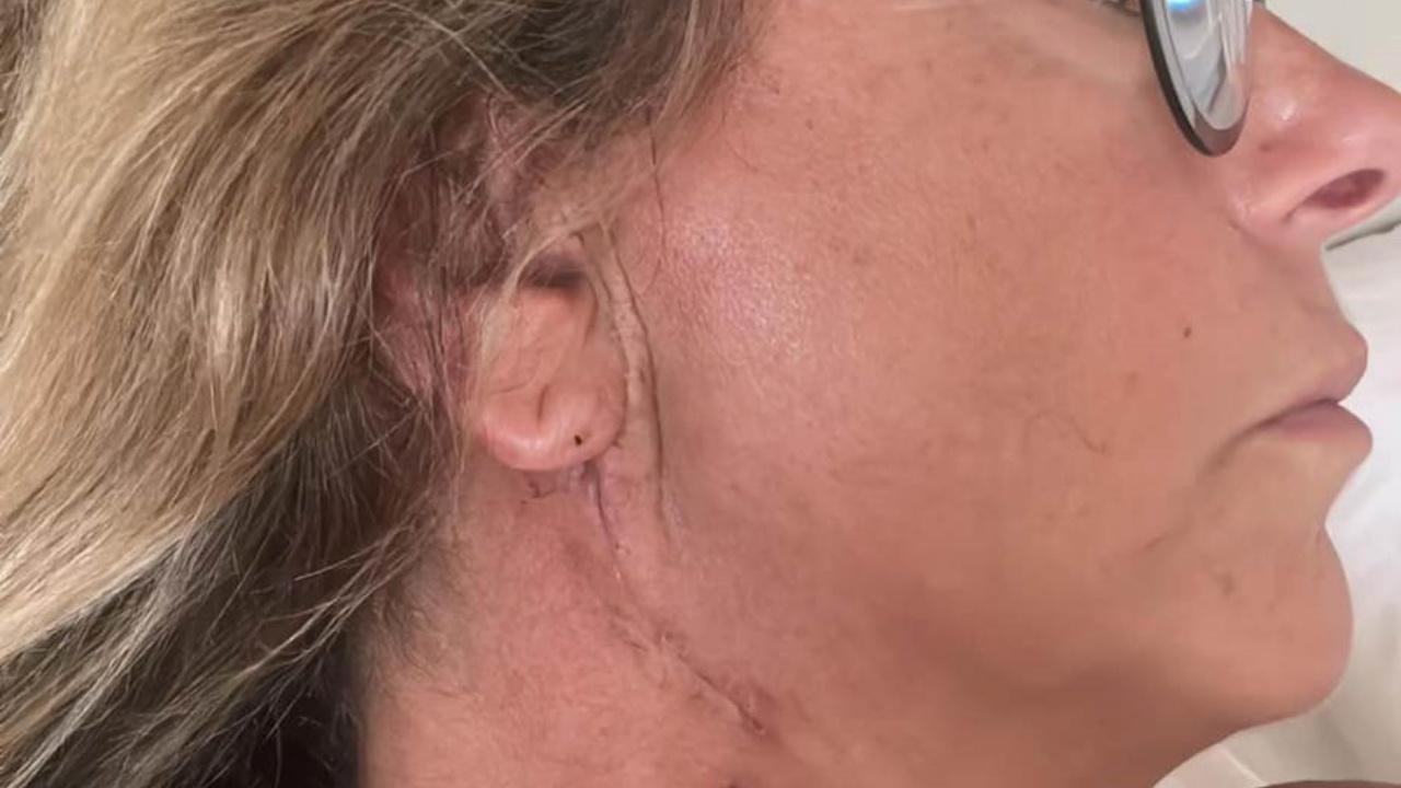 Roberta Beta Adenoma
