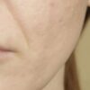 macchia viso tumore
