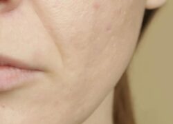 macchia viso tumore