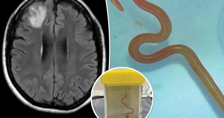 donna di 64 anni verme nel cervello