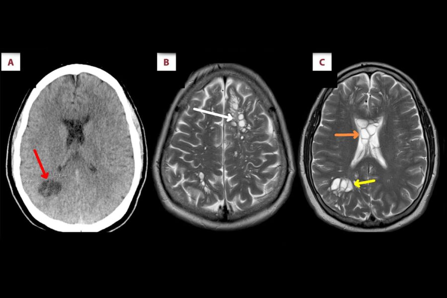 Pancetta letale, l'uomo col problema al cervello