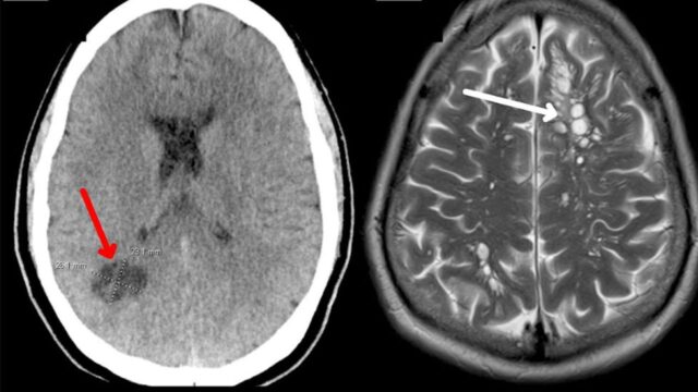 Un uomo si reca dai medici accusando forti mal di testa, ma quello che scopre è a dir poco orribile: la scoperta lascia tutti sotto choc