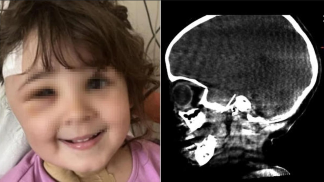 Bambina finisce in ospedale per un ago nel cervello