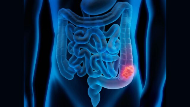 Tumore al colon, allarmante l’aumento di casi nei giovani: come sospettarlo