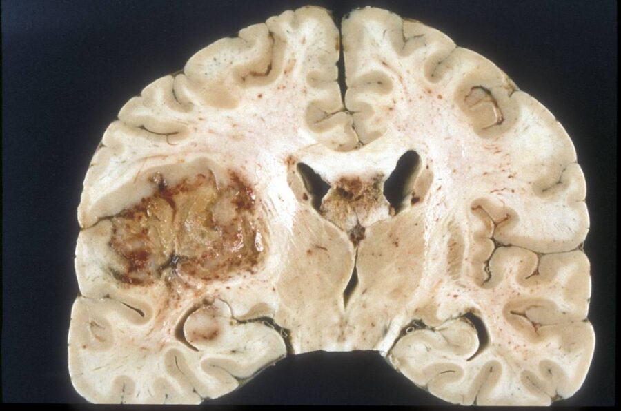 tumore al cervello