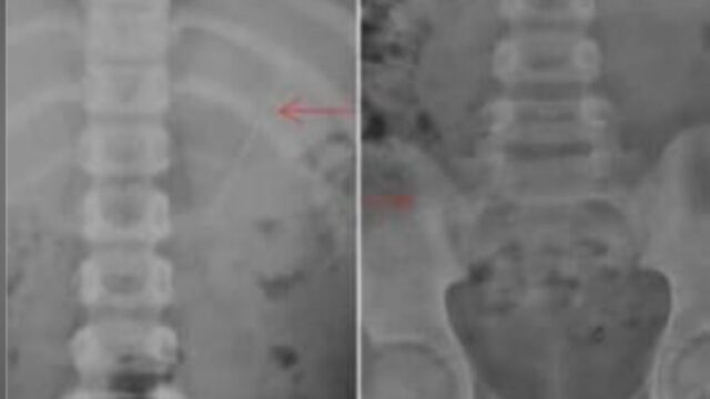 “Caso strano e unico” Bimbo di 7 anni vivo per miracolo, lo stupore dei medici: la radiografia mostra qualcosa di incredibile