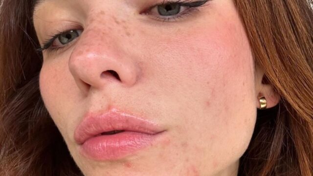 La famosa attrice mostra sui social le conseguenze del suo disturbo, la foto con l’acne e le imperfezioni fa il giro del web