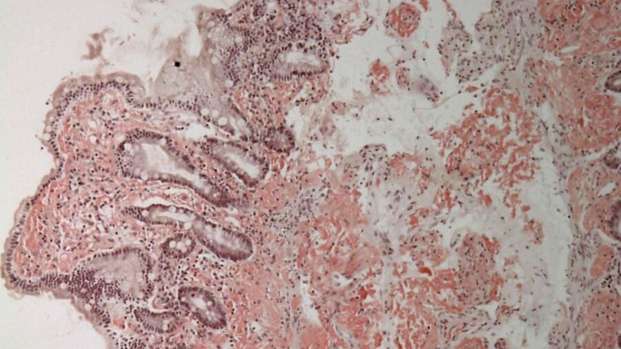 amiloidosi, la malattia di cui soffre Oliviero Toscani