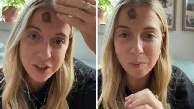 “Mi sono svegliata pensando fosse un brufolo, invece era qualcosa di più grave” la storia di questa 32 anni è straziante