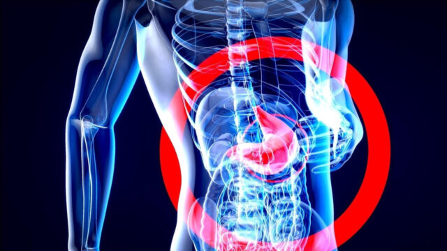 Questo batterio molto comune provoca il cancro allo stomaco: come prevenirlo per ridurre il rischio